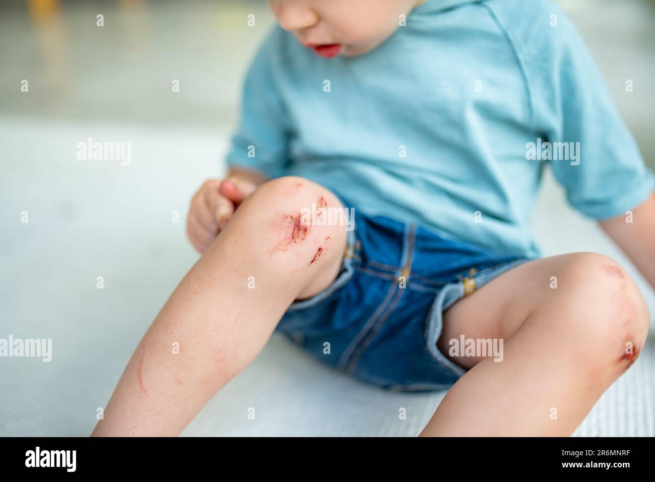 Toddler boy with sore scraped knees. Parent helping her child perform first aid knee injury after he has been an accident. Stock Photo