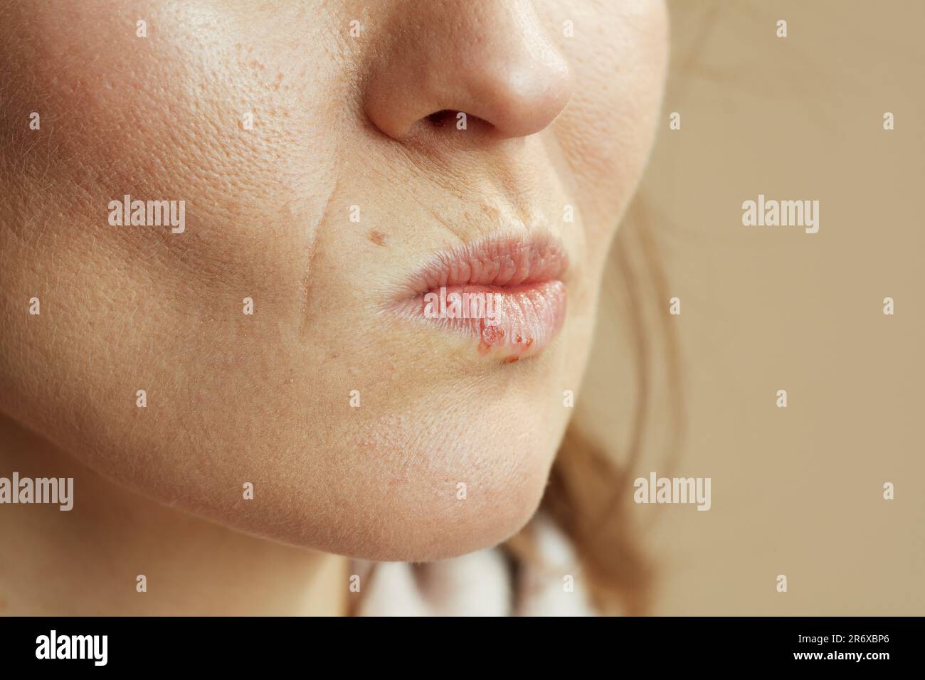 Closeup on woman with herpes on lips isolated on beige background. Stock Photo