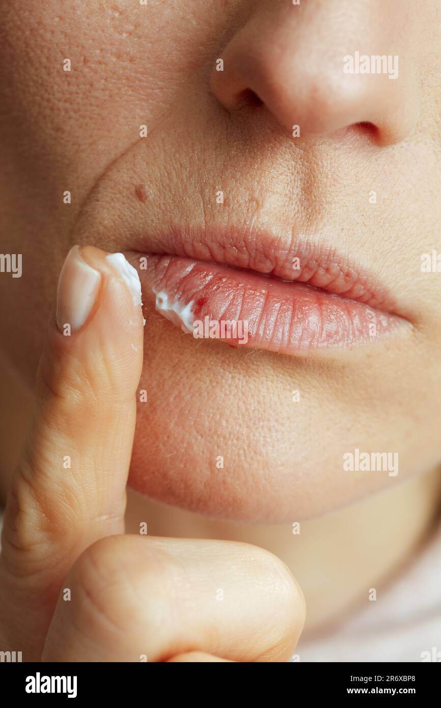 Closeup on 40 years old woman with herpes on lips applying ointment using finger on beige background. Stock Photo