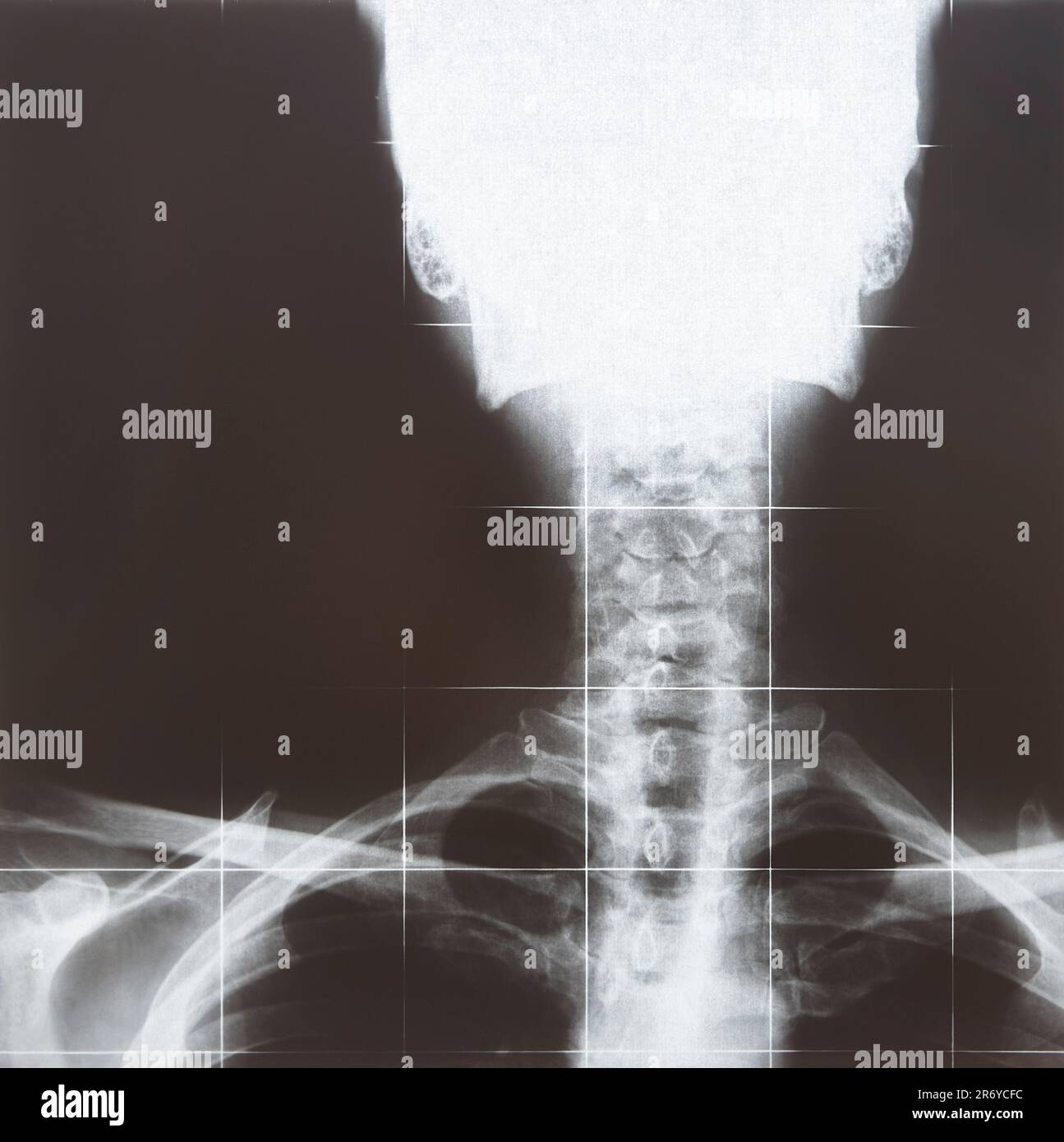 XRays resonance imaging. Spinal column detail. Medical procedure