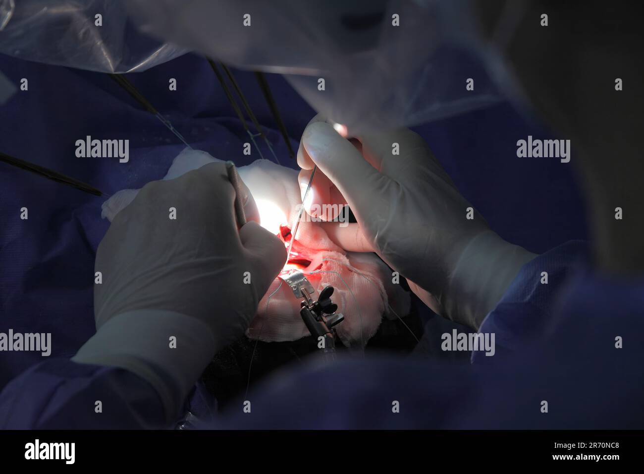 Treatment of a brain aneurysm. Surgical operation on the brain. A team of surgeons performing brain surgery to remove a tumor Stock Photo