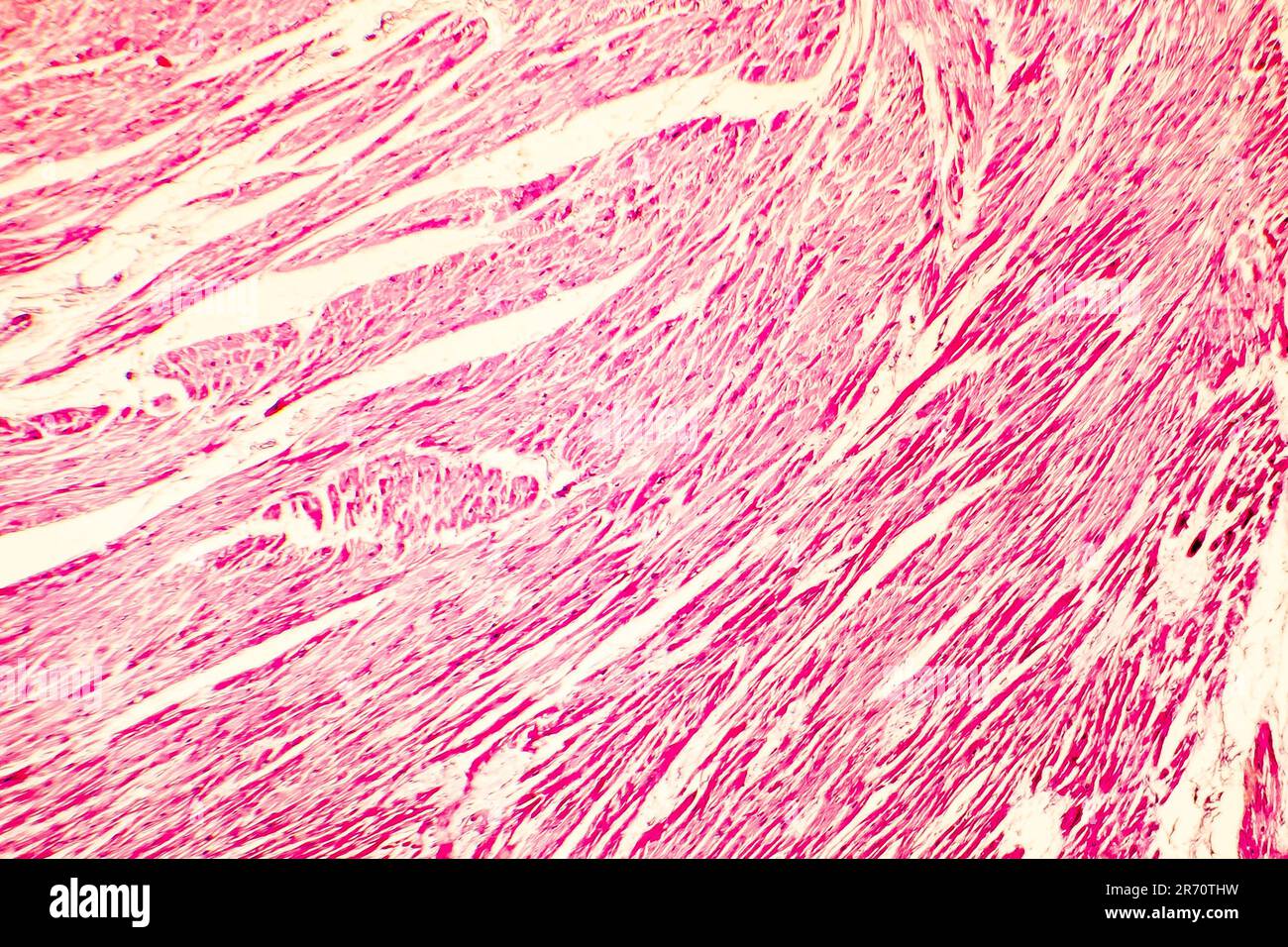 Heart hypertrophy. Photomicrograph showing hypertrophic myocardium with thick muscle fibers and enlarged and dark nuclei Stock Photo