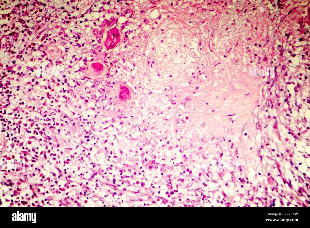 Liquefactive necrosis of the human brain, light photomicrograph showing loss of cell outlines