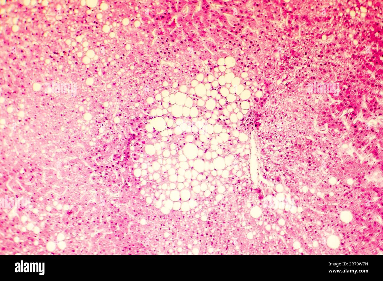 Fatty liver, liver steatosis. Photomicrograph showing large vacuoles of
