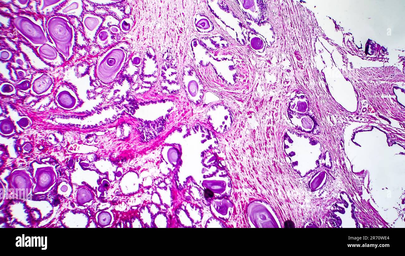 Histopathology of prostate gland hyperplasia, light micrograph, photo under microscope Stock