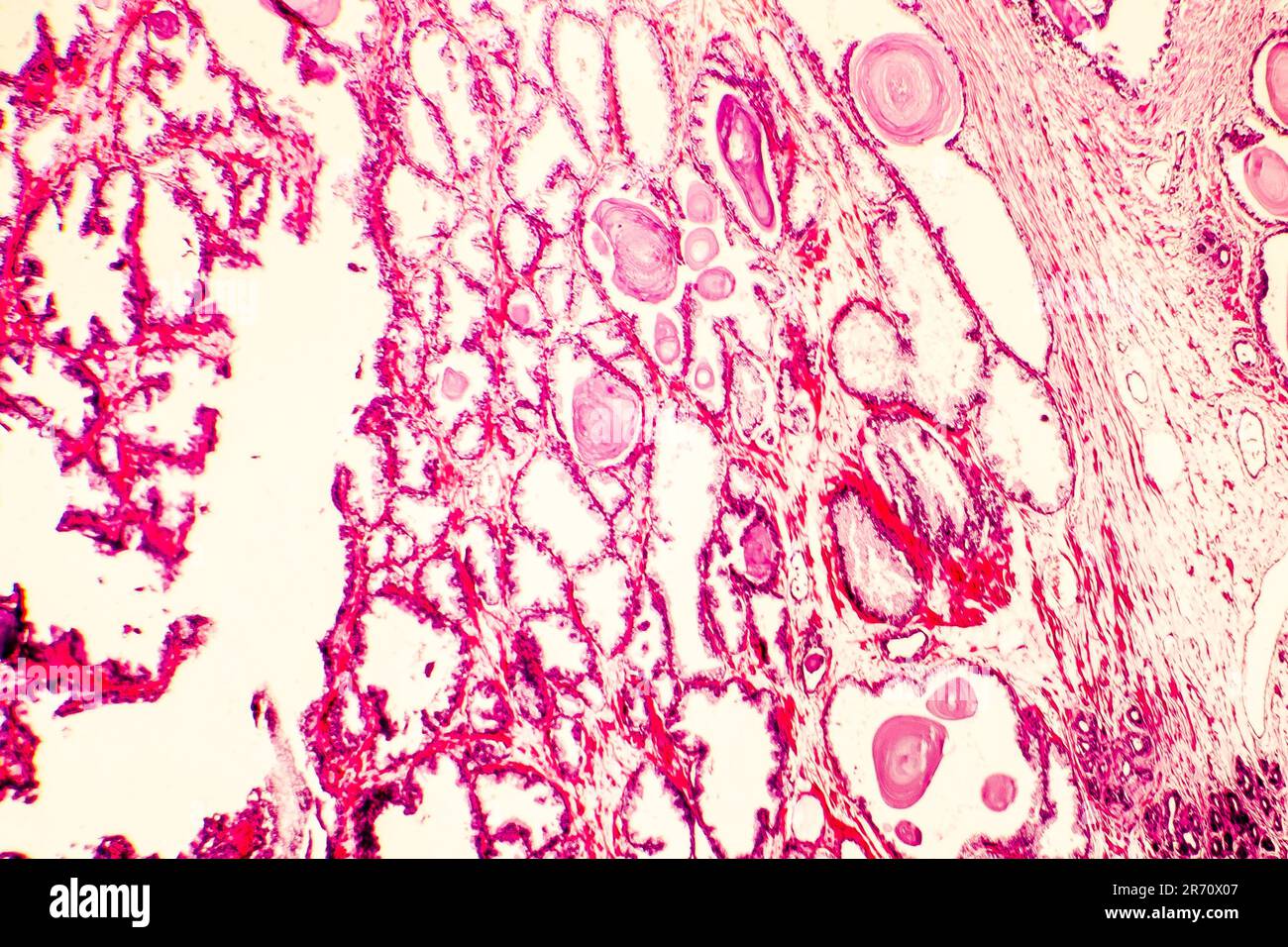 Prostate hyperplasia. Photomicrograph showing dilated glands, enfolding of the glandular epithelial cells forming papillary projections into the gland Stock Photo