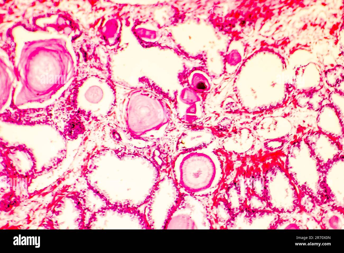 Prostate hyperplasia. Photomicrograph showing dilated glands, papillary ...