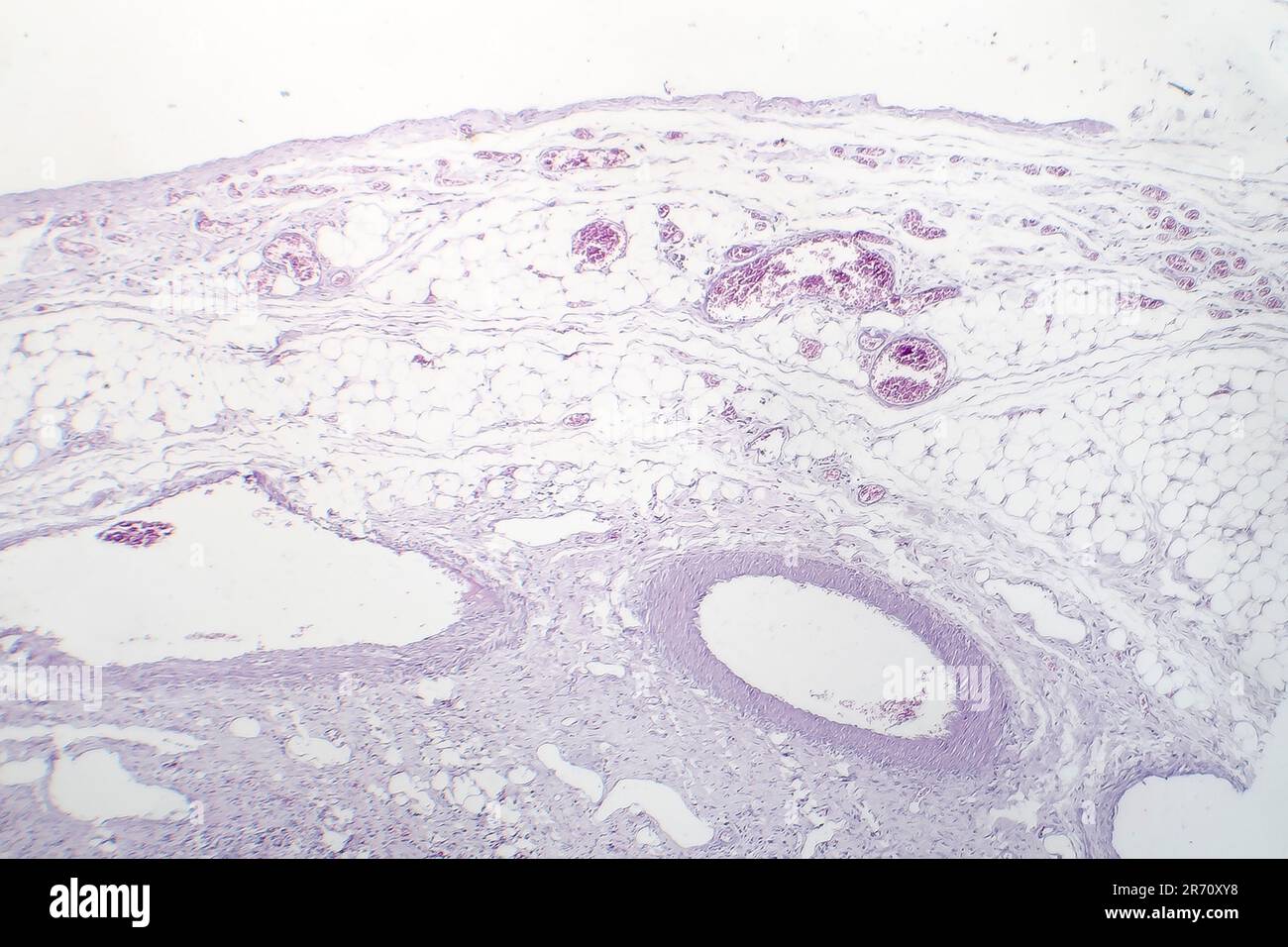 Granulomatous inflammation, light micrograph, photo under microscope Stock Photo