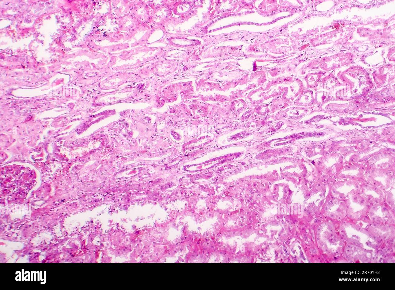 Edema of renal tubular epithelial cells in kidney failure, light
