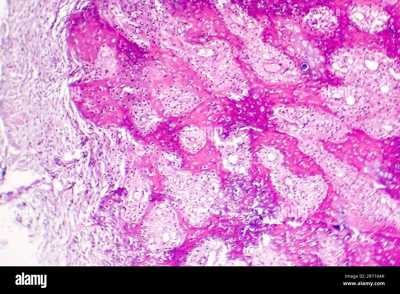 Histology of callus, a thickened skin made as a result of pressure