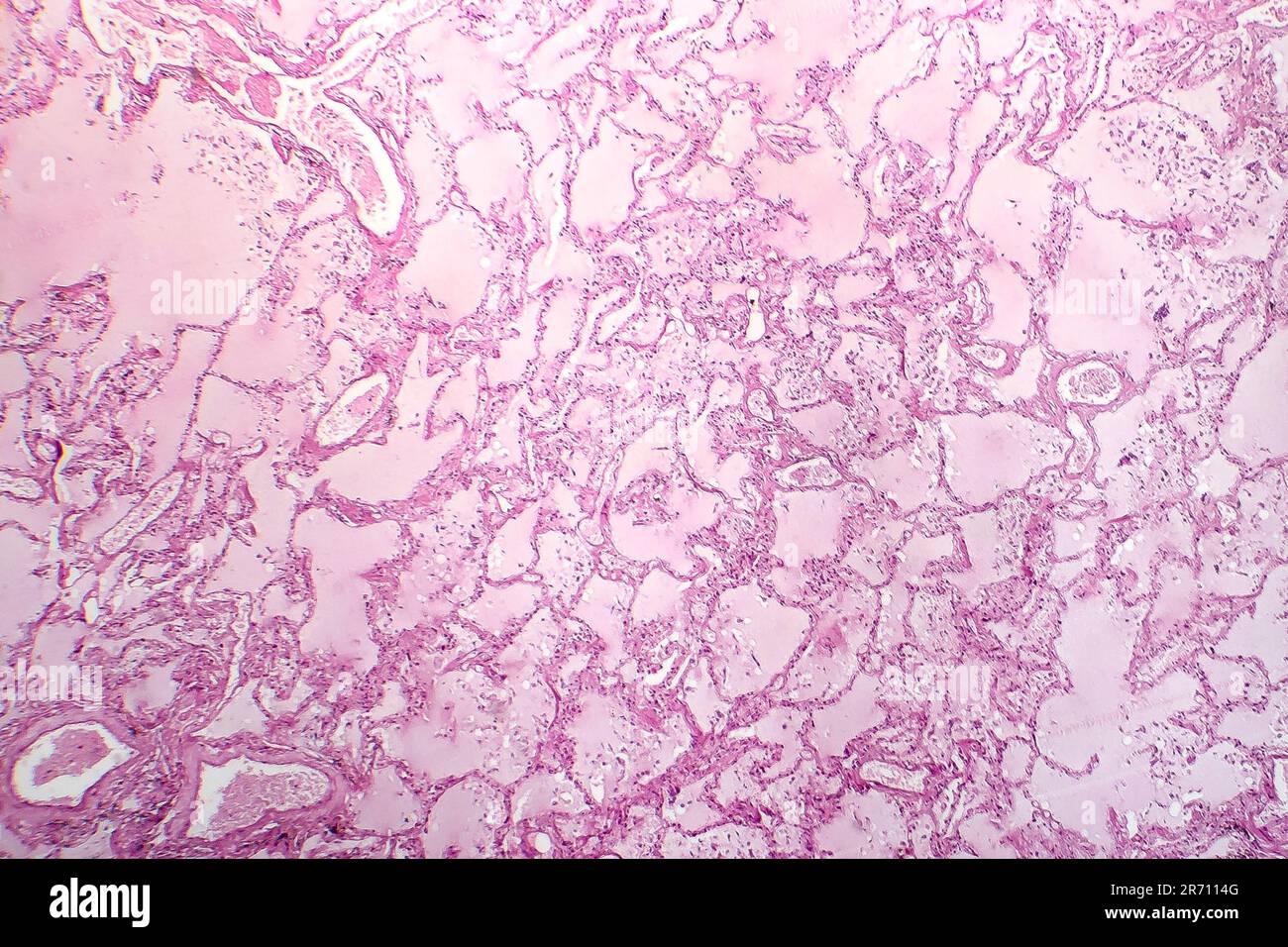 Histopathology of acute pulmonary edema, light micrograph showing  accumulation of fluid inside alveoli Stock Photo - Alamy