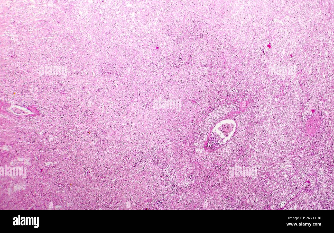 Splenic infarction, light micrograph, photo under microscope Stock Photo