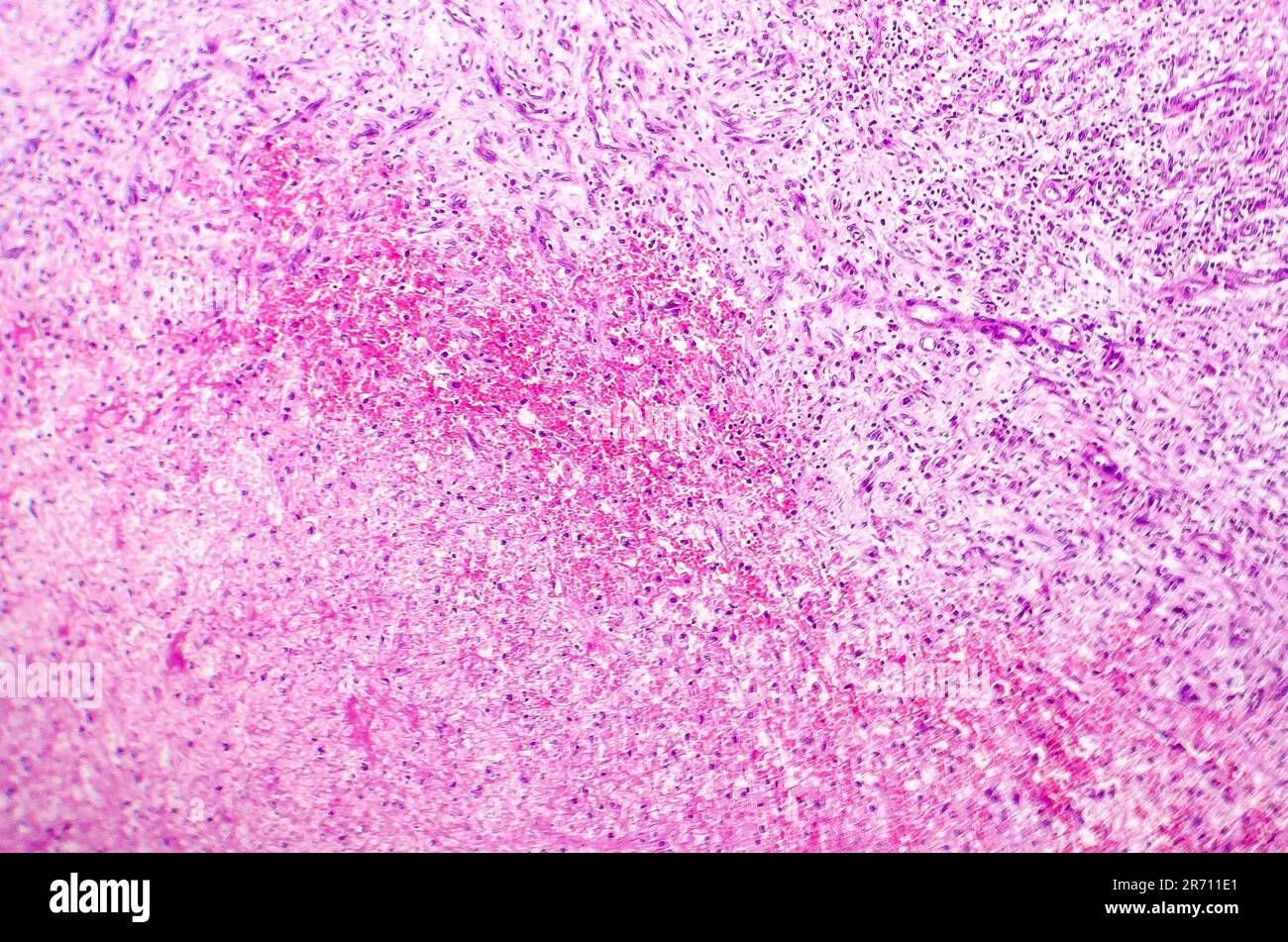 Splenic infarction, light micrograph, photo under microscope Stock ...