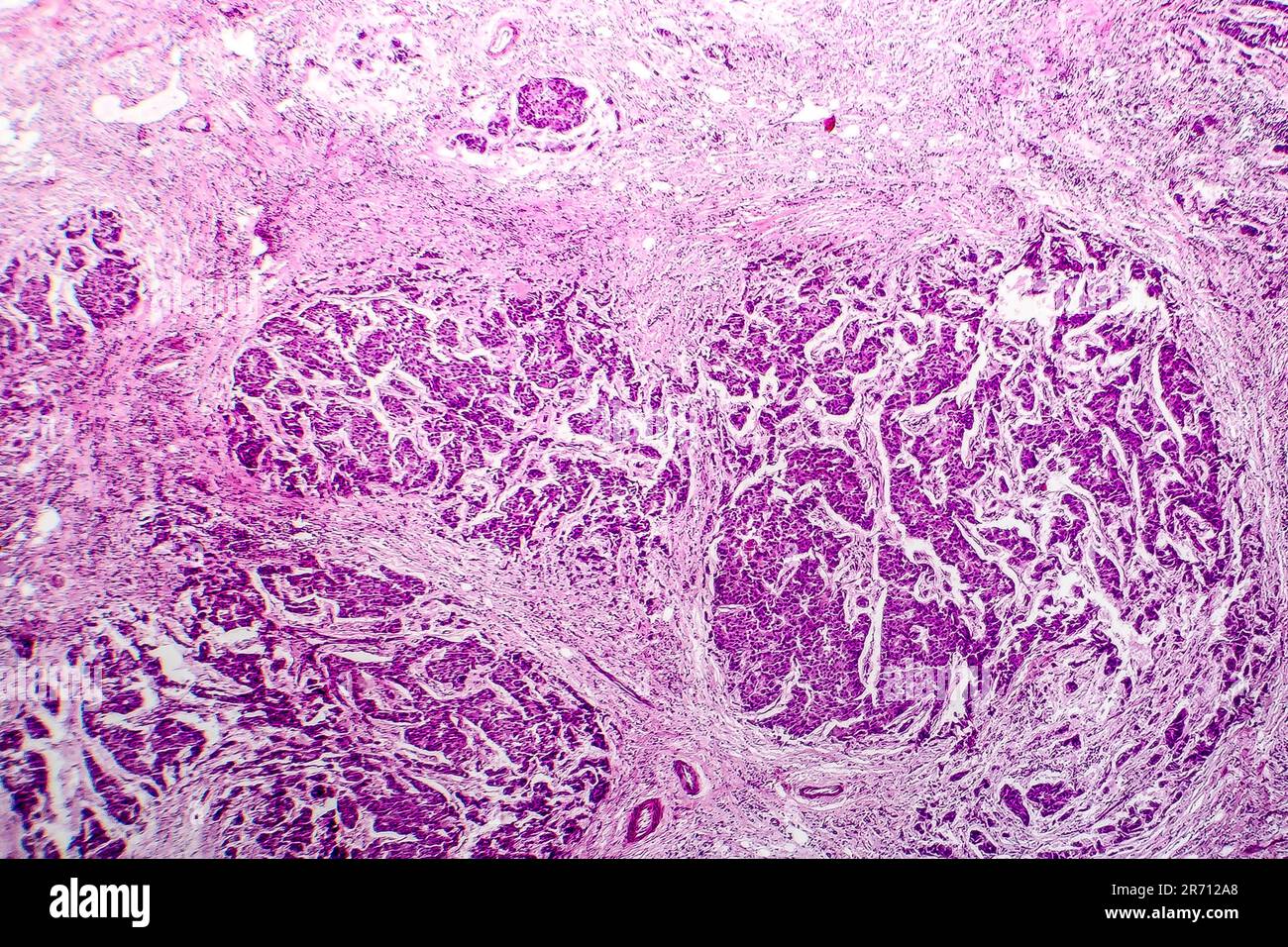 Lymph node metastasis, light micrograph of cancer that has spread to a ...
