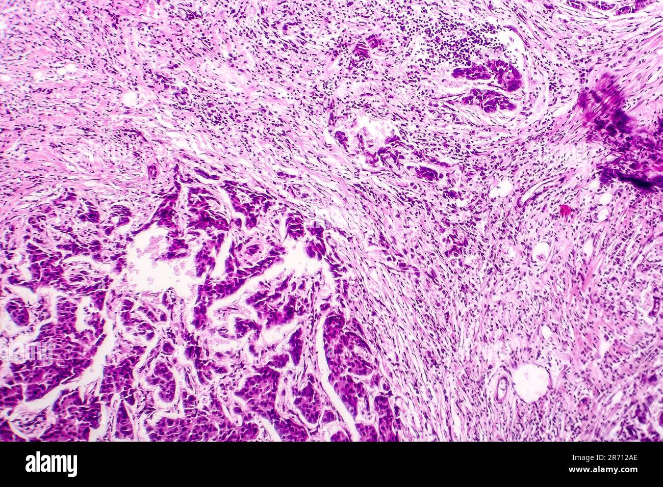 Lymph node metastasis, light micrograph of cancer that has spread to a ...