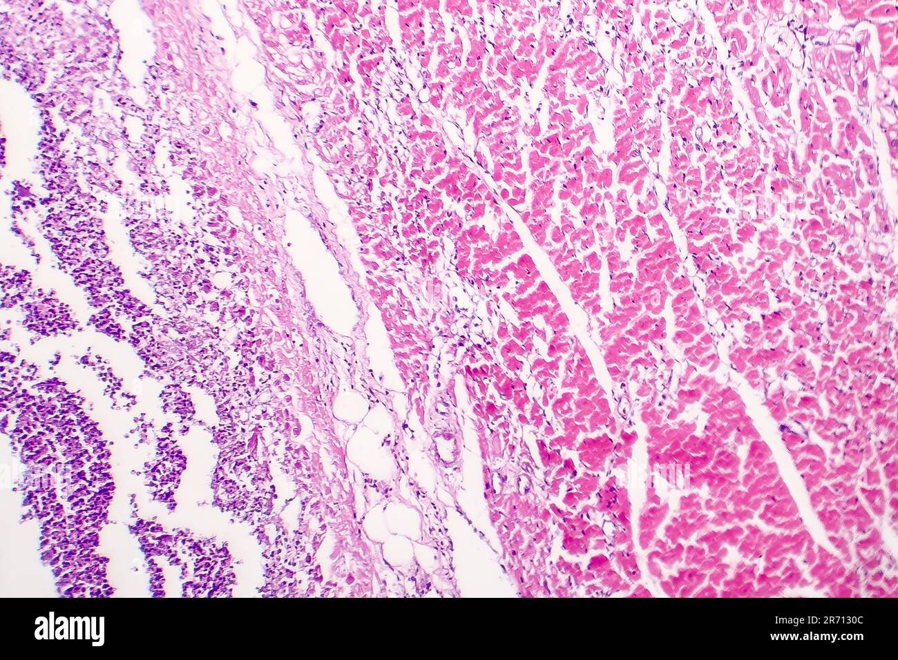 Heart Micrograph Histopathology of bacterial myocarditis, inflammatory heart disease ...