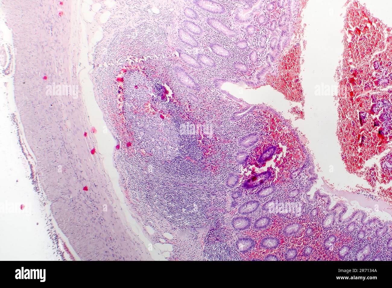 Histopathology of chronic appendicitis, light micrograph, photo under microscope Stock Photo Alamy