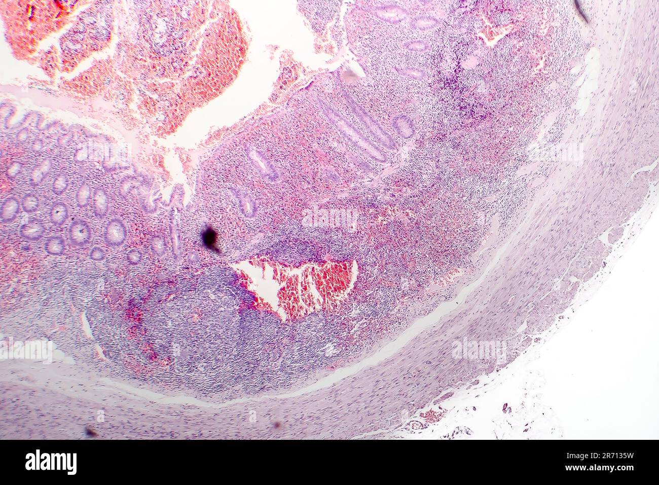 Histopathology of chronic appendicitis, light micrograph, photo under microscope Stock Photo Alamy