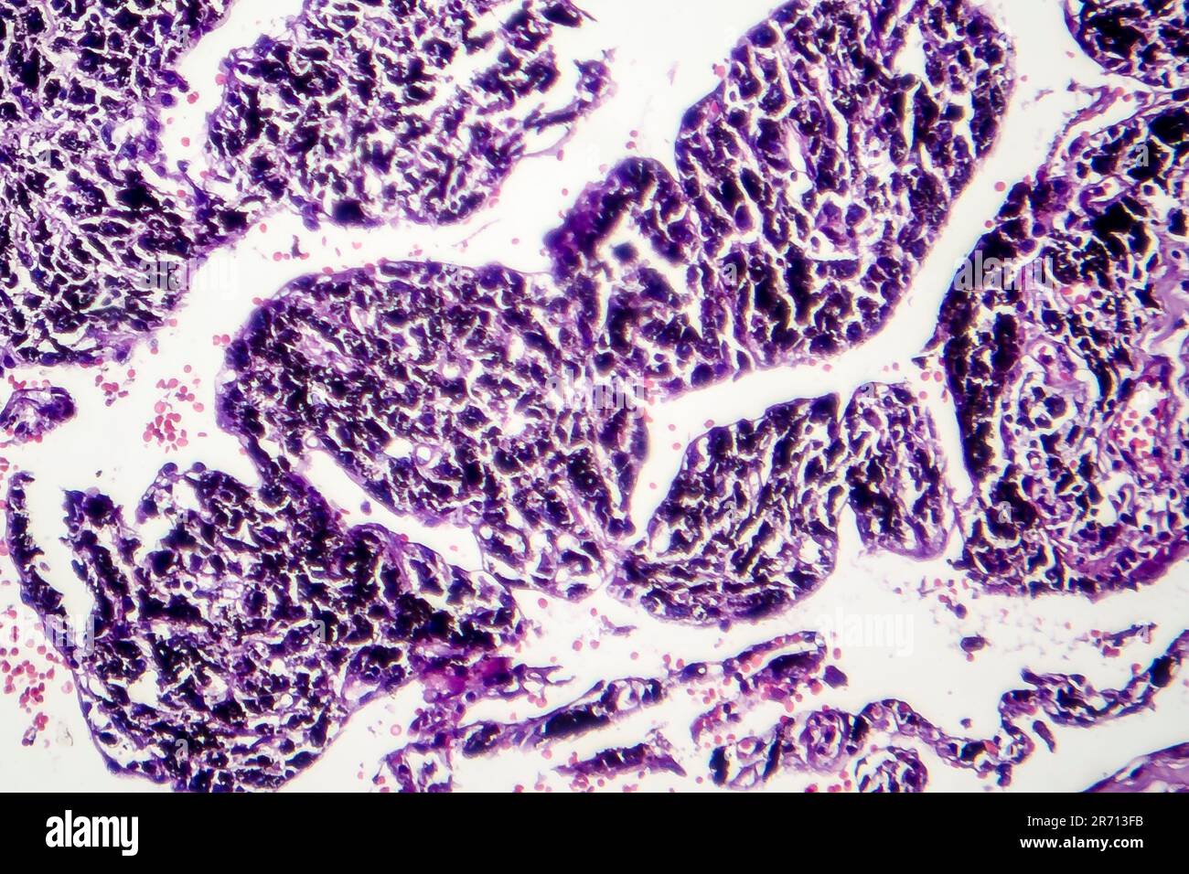 Smoker's lung, histopathology, light micrograph showing accumulation of