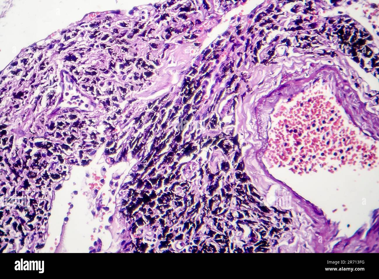 Smoker's lung, histopathology, light micrograph showing accumulation of