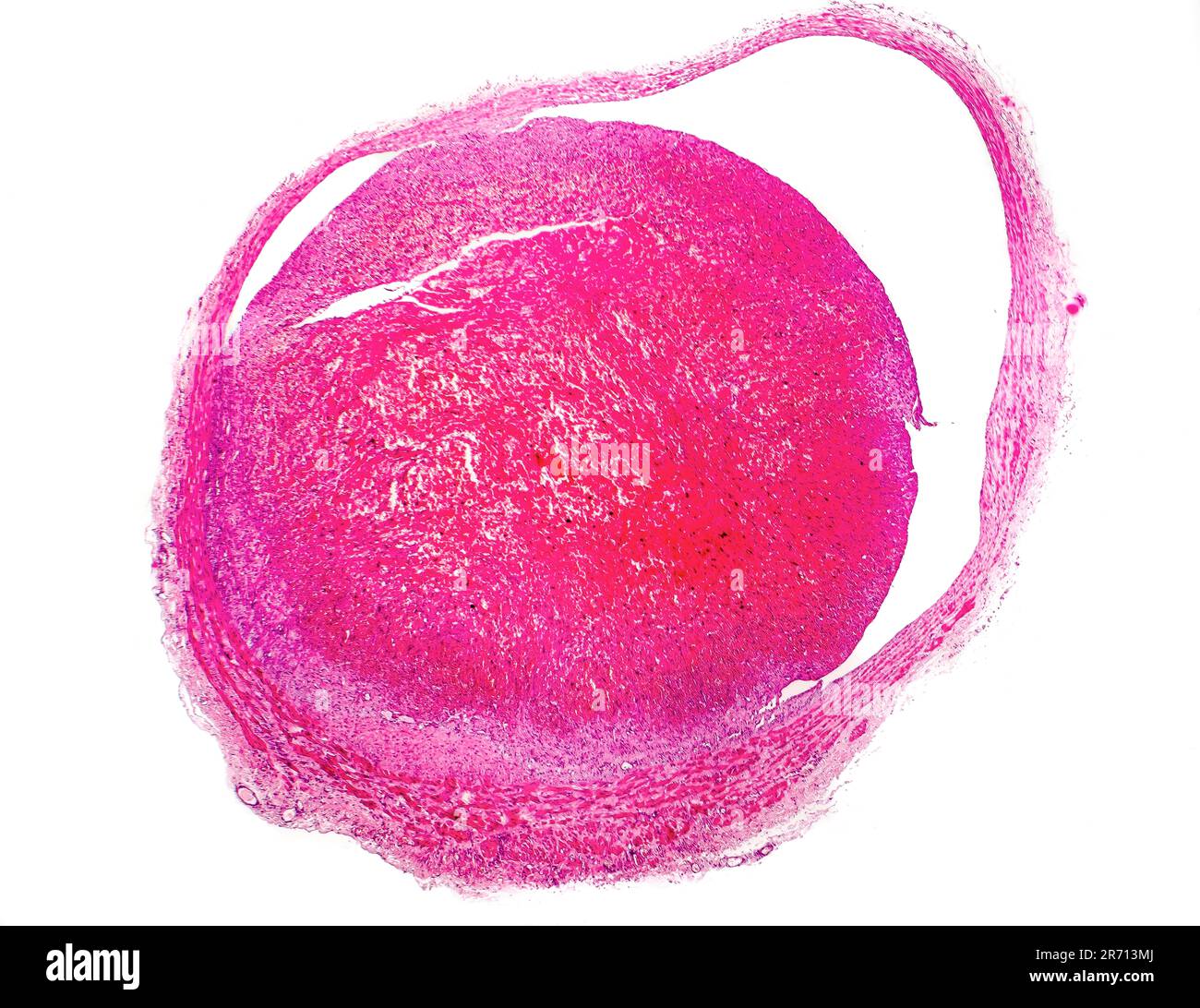 Thrombus inside blood vessel, light micrograph, hematoxylin and eosin staining Stock Photo