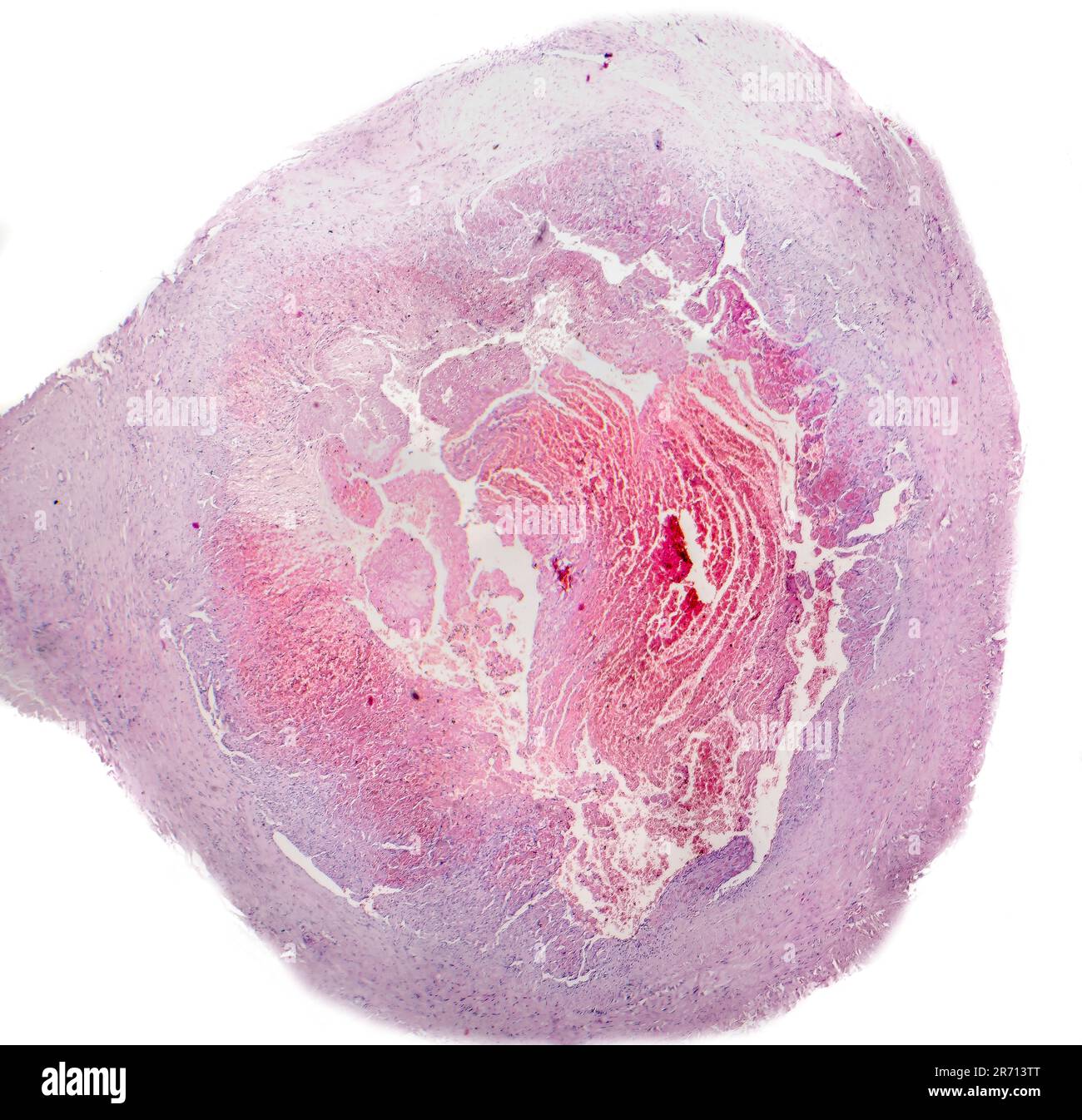 Thrombus inside vein, light micrograph, hematoxylin and eosin staining Stock Photo