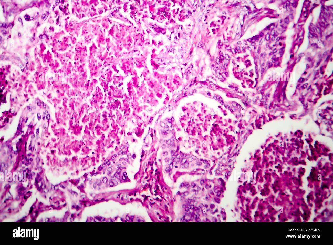 Lung adenocarcinoma, light micrograph, photo under microscope Stock Photo