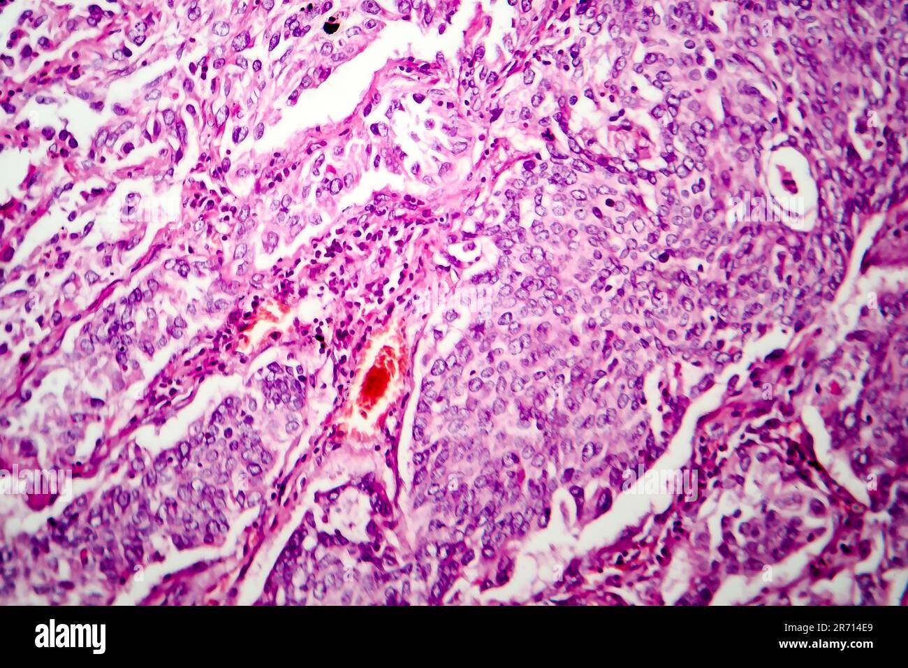 Lung adenocarcinoma, light micrograph, photo under microscope Stock Photo