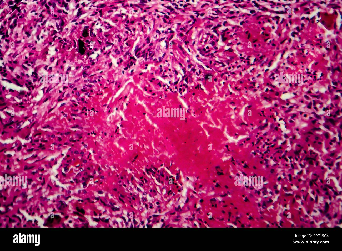 Miliary tuberculosis, light micrograph, photo under microscope Stock Photo