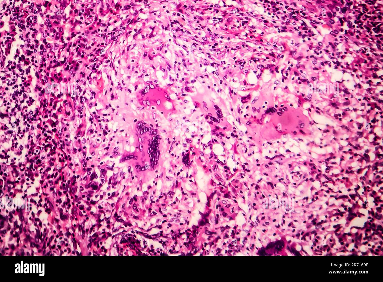 Histopathology of tubercle, light micrograph, photo under microscope Stock Photo Alamy