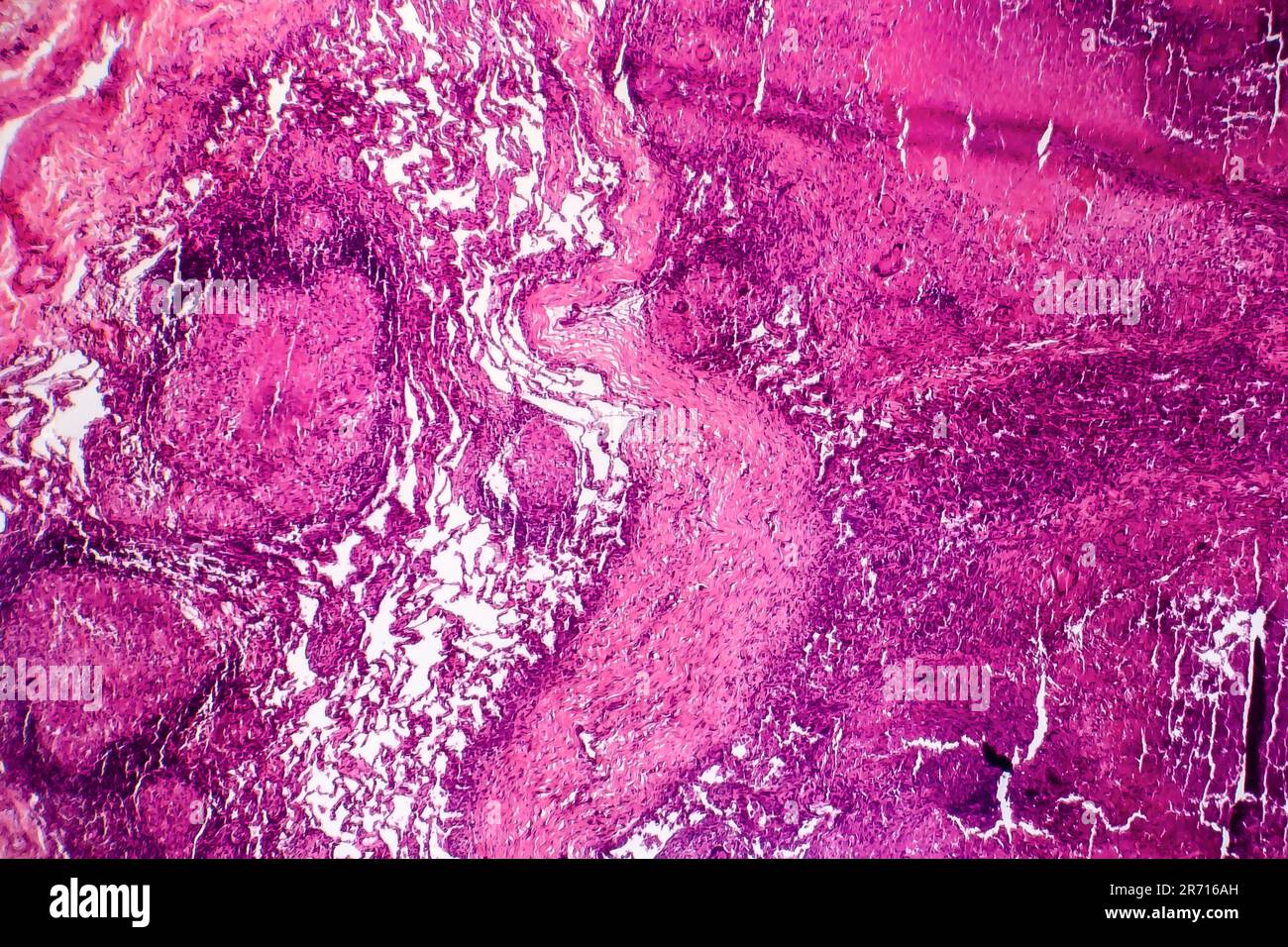 Caseous pneumonia, light micrograph, photo under microscope. Tuberculosis pneumonia Stock Photo