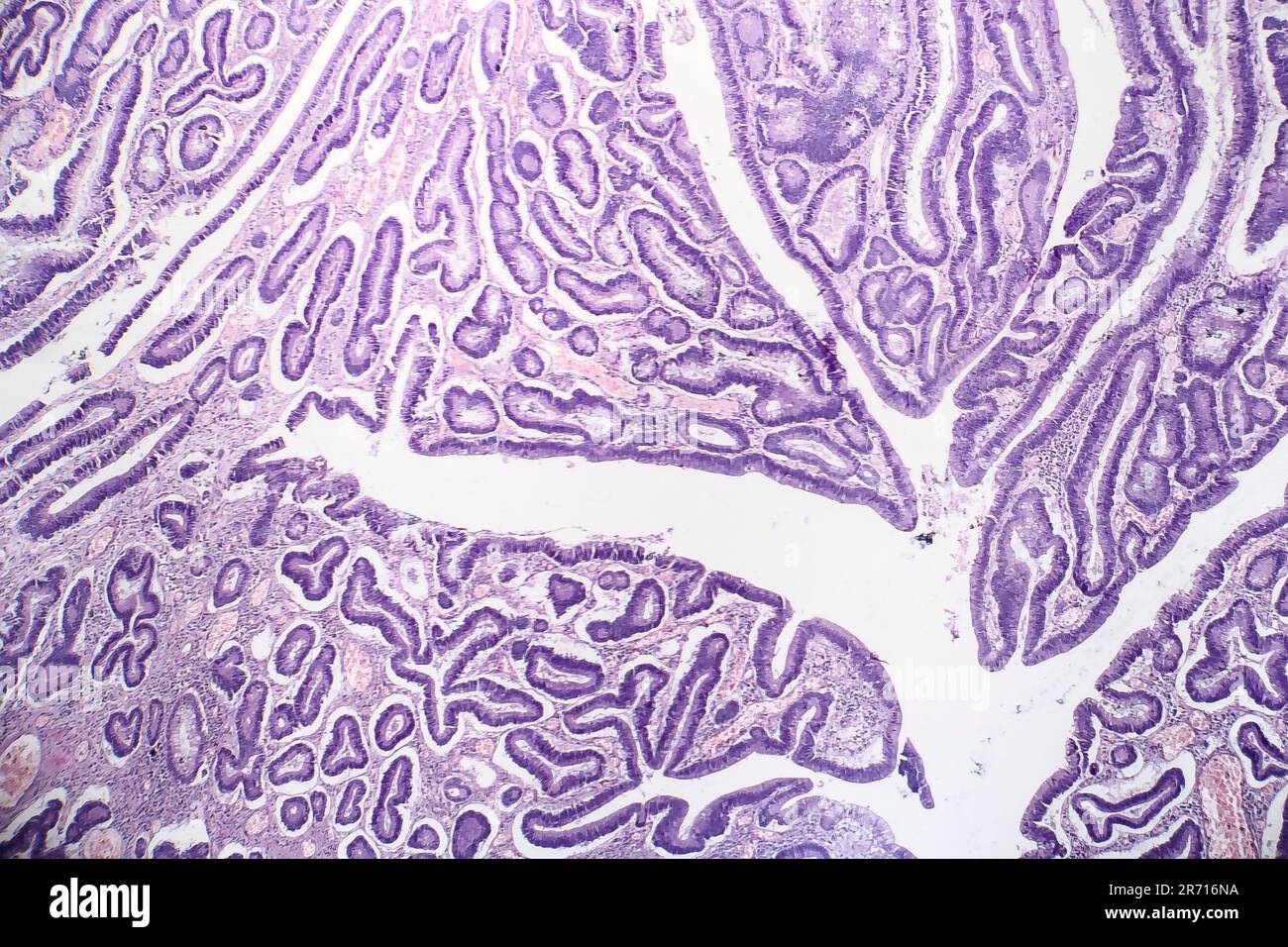 Histopathology of intestinal adenoma, light micrograph, photo under microscope Stock Photo Alamy