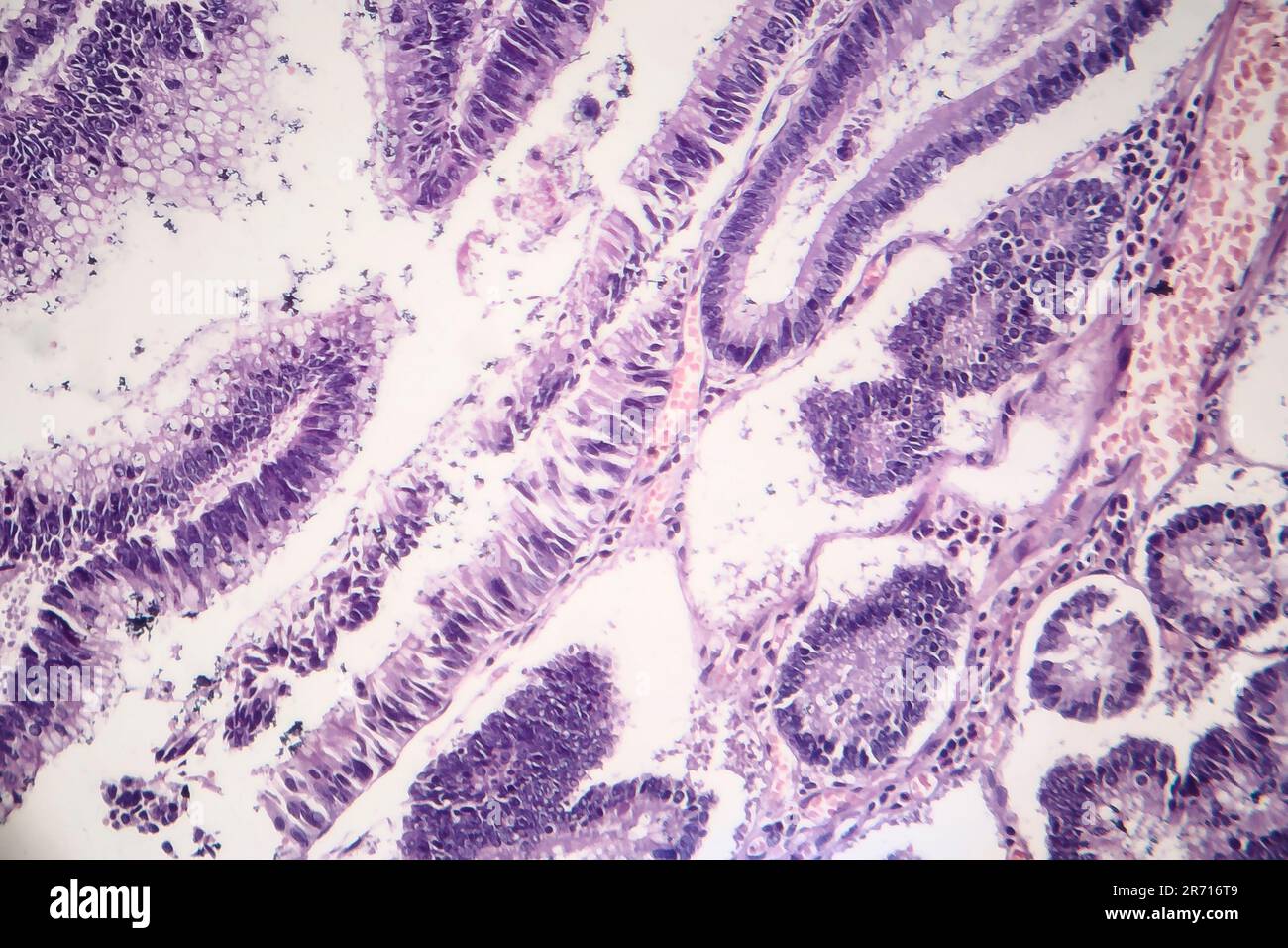 Histopathology of intestinal adenoma, light micrograph, photo under microscope Stock Photo Alamy