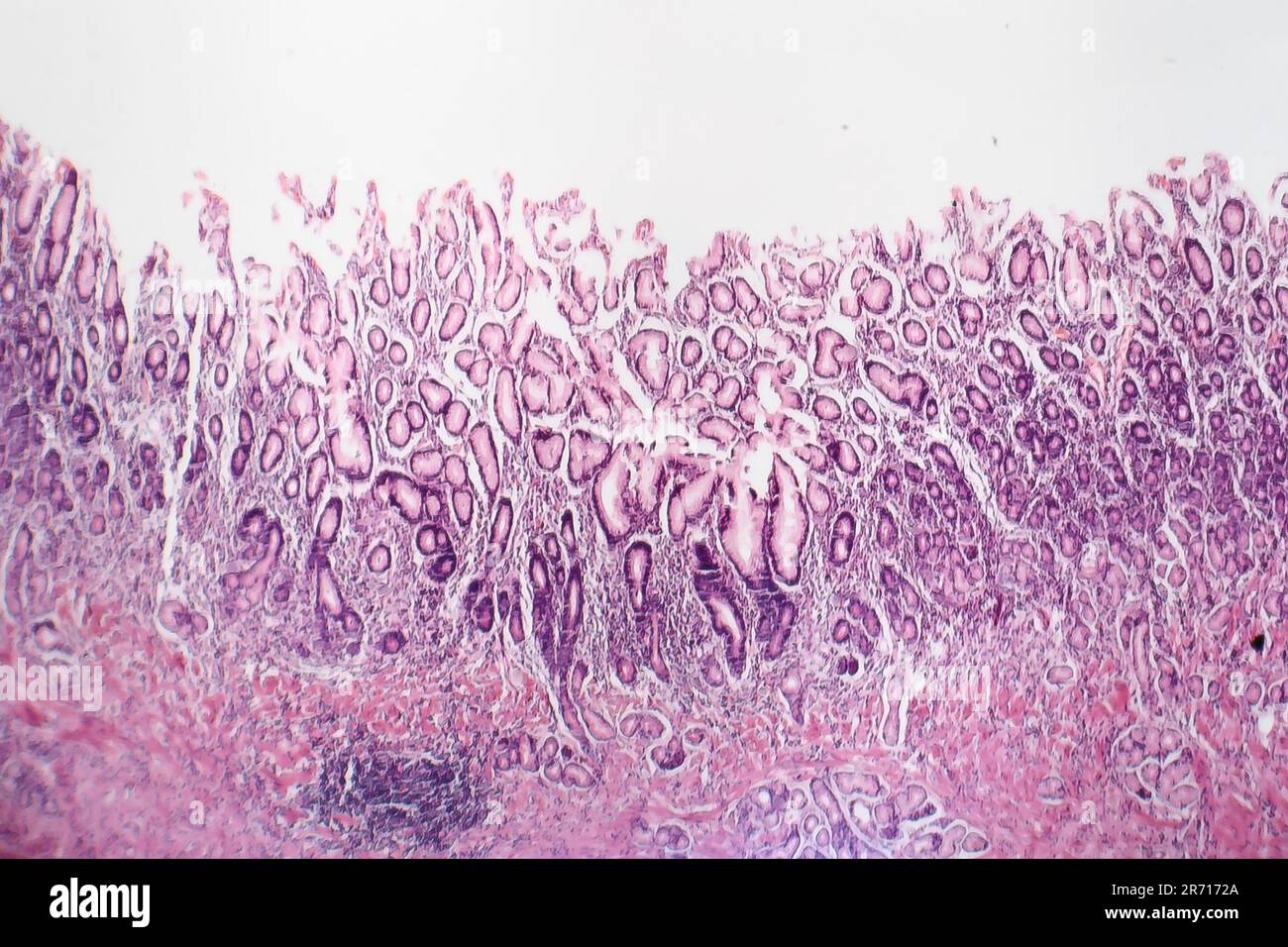 Atrophic Gastritis Histology