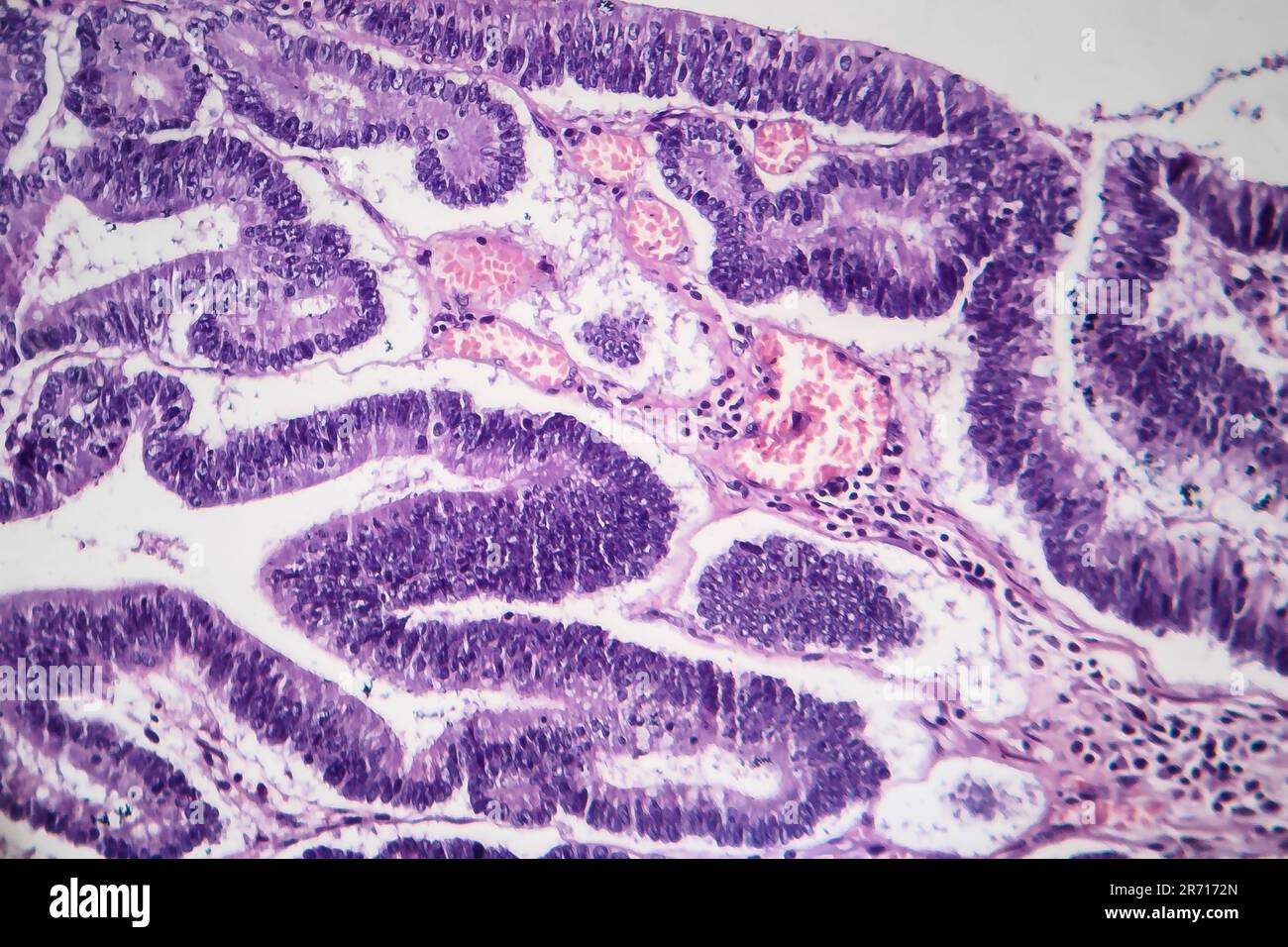 Histopathology of intestinal adenoma, light micrograph, photo under microscope Stock Photo Alamy