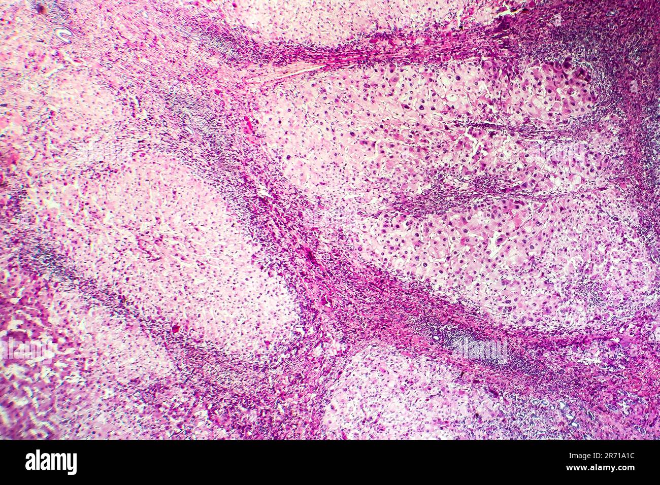 Histopathology Of Portal Liver Cirrhosis Light Micrograph Photo Under Microscope Stock Photo