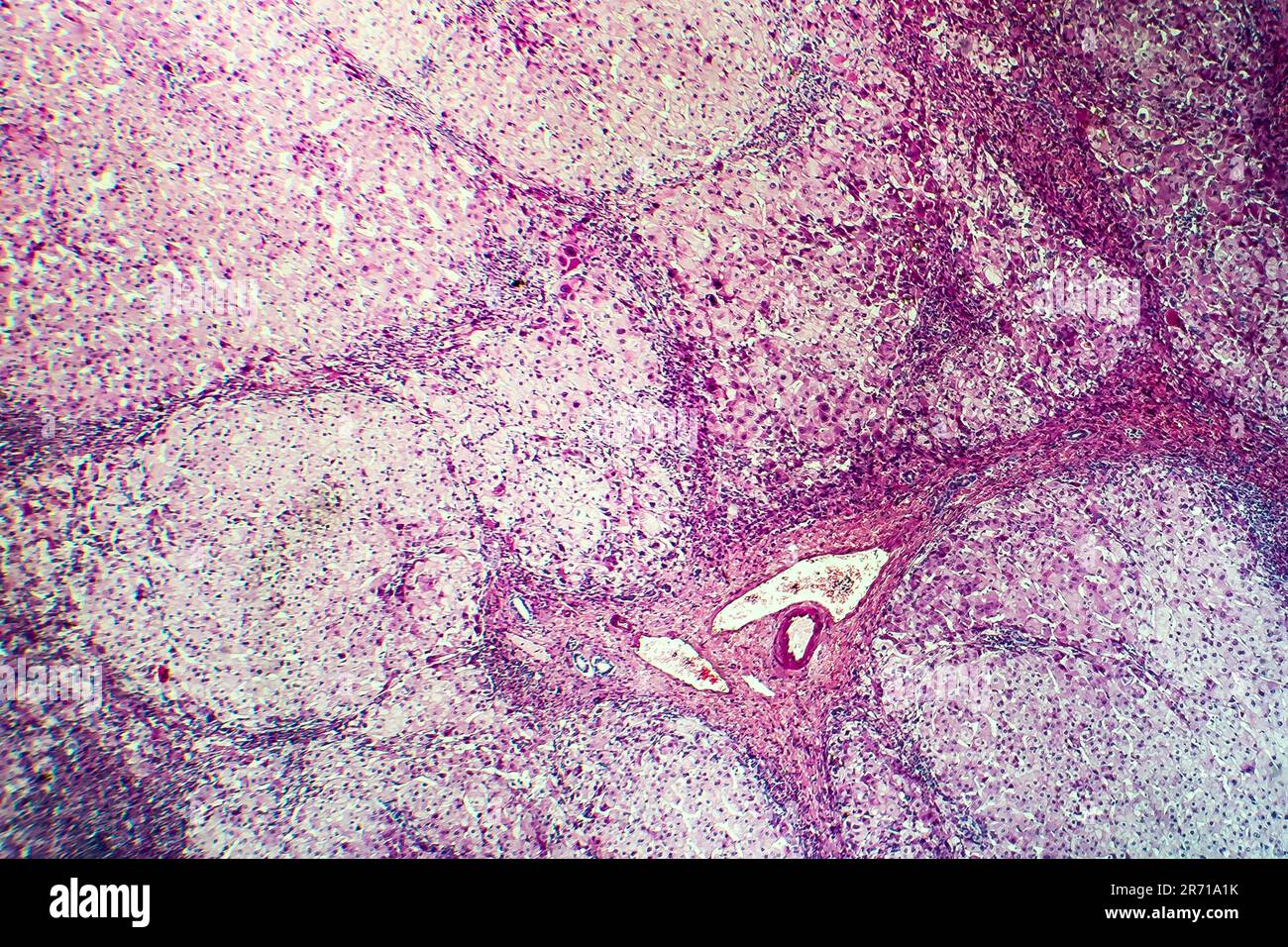 Histopathology of portal liver cirrhosis, light micrograph, photo under  microscope Stock Photo - Alamy