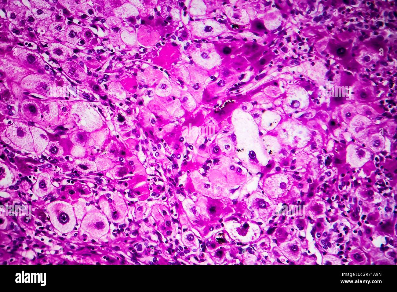 Histopathology Of Portal Liver Cirrhosis Light Micrograph Photo Under Microscope Stock Photo