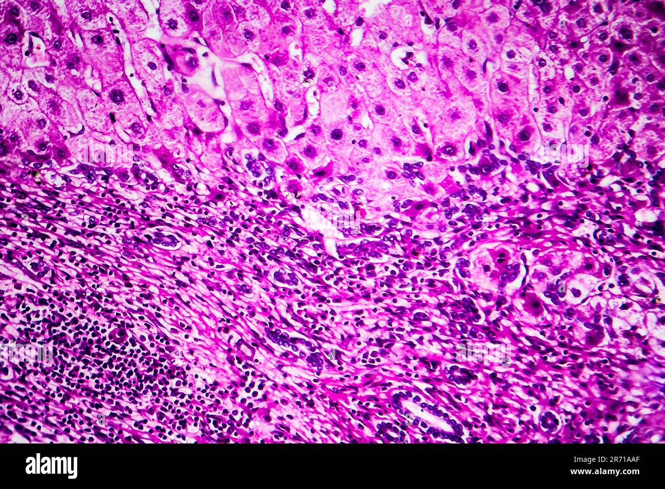Histopathology of portal liver cirrhosis, light micrograph, photo under microscope Stock Photo