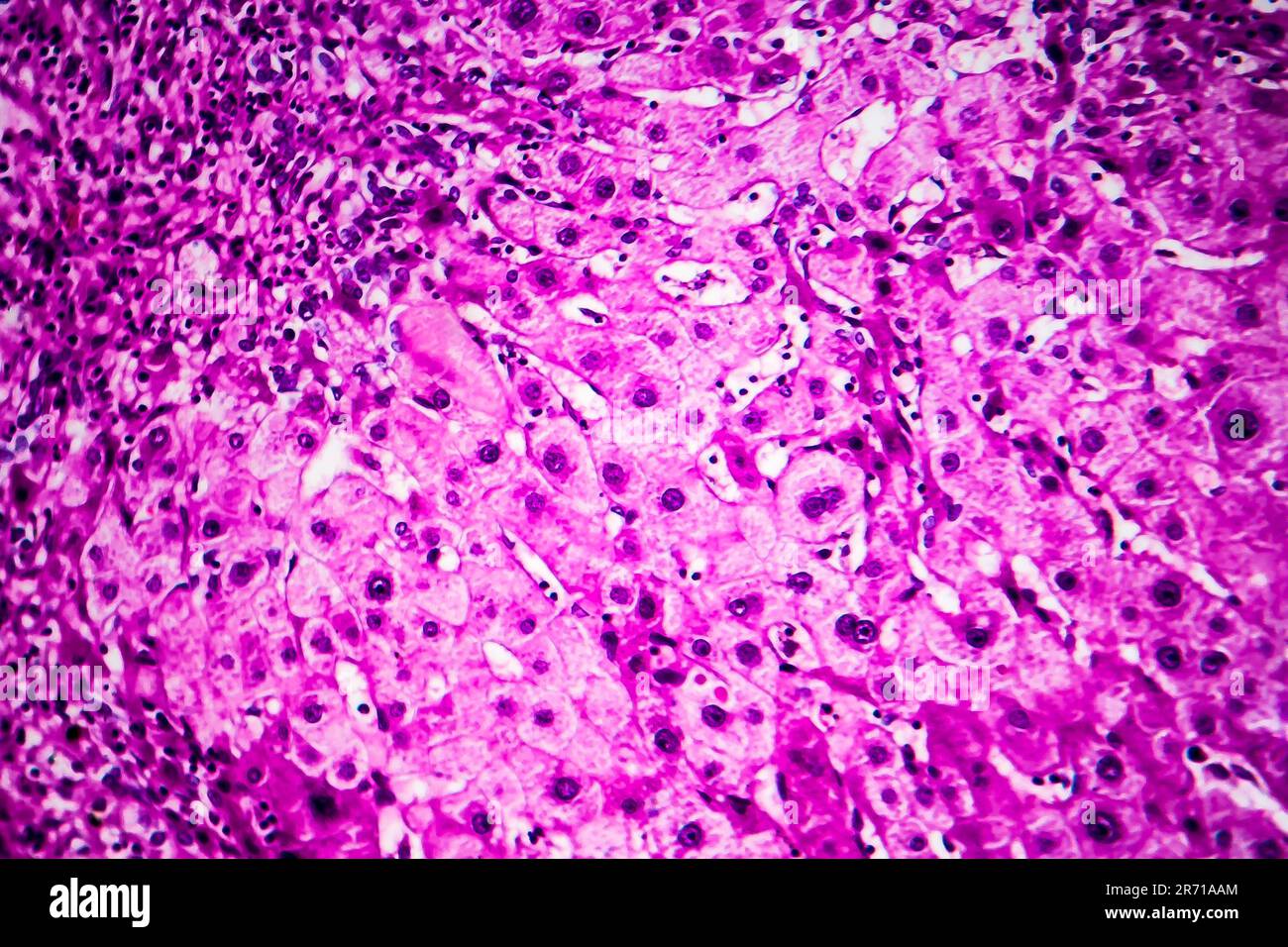 Histopathology of portal liver cirrhosis, light micrograph, photo under ...