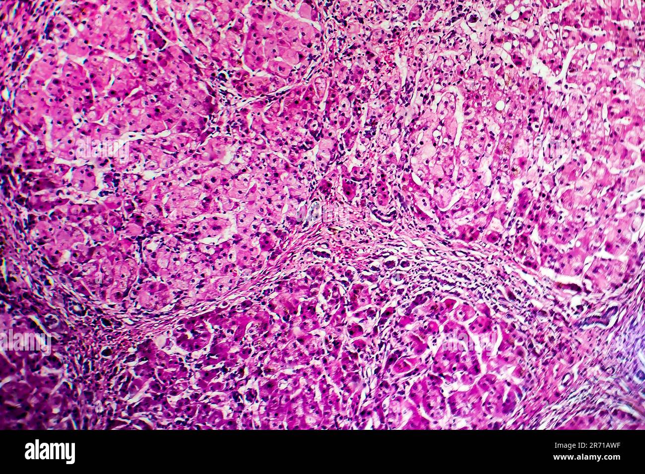 Histopathology of biliary liver cirrhosis, light micrograph, photo under microscope Stock Photo