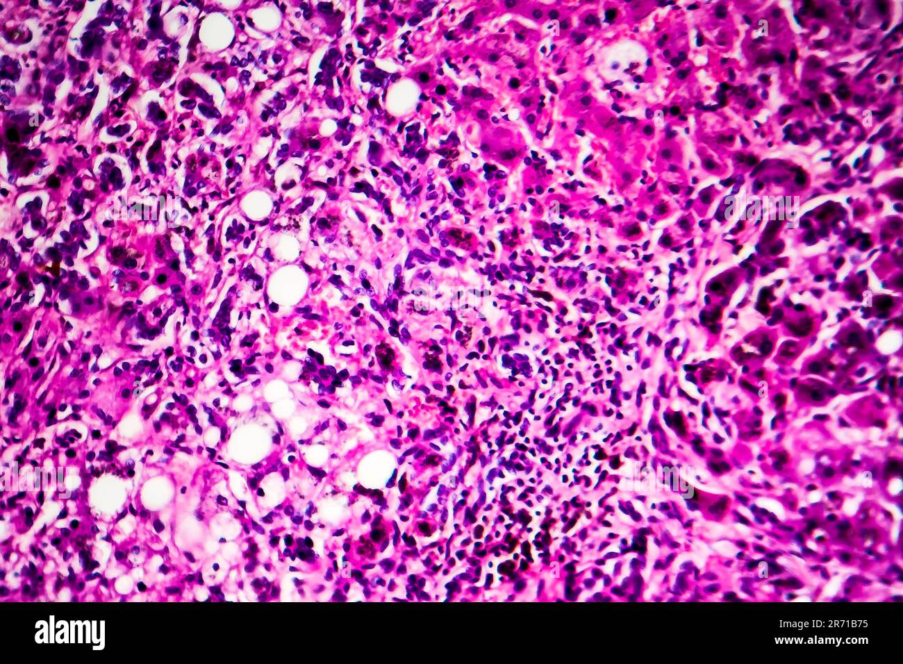 Histopathology of biliary liver cirrhosis, light micrograph, photo under microscope Stock Photo