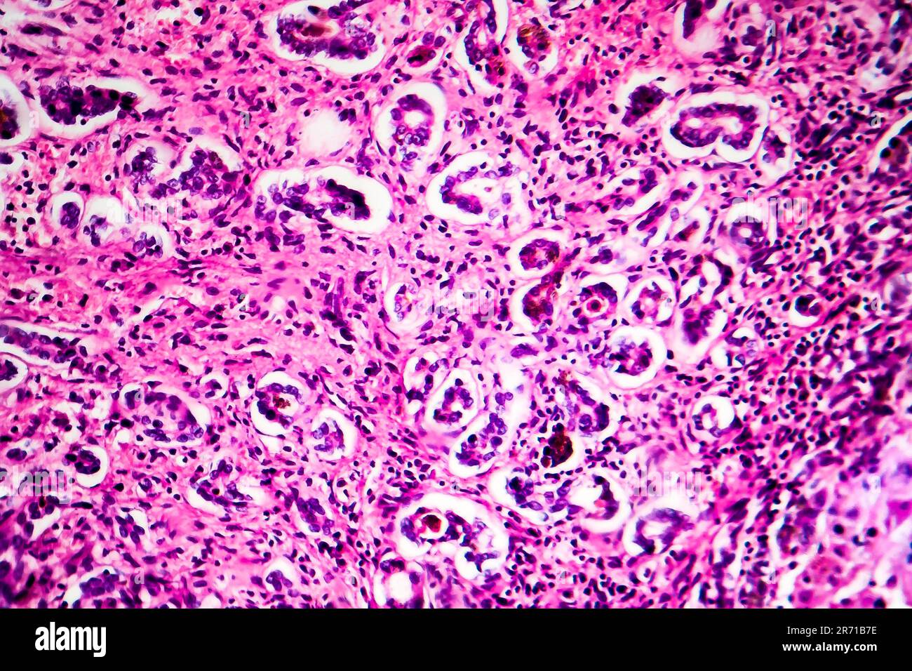 Histopathology of biliary liver cirrhosis, light micrograph, photo under microscope Stock Photo