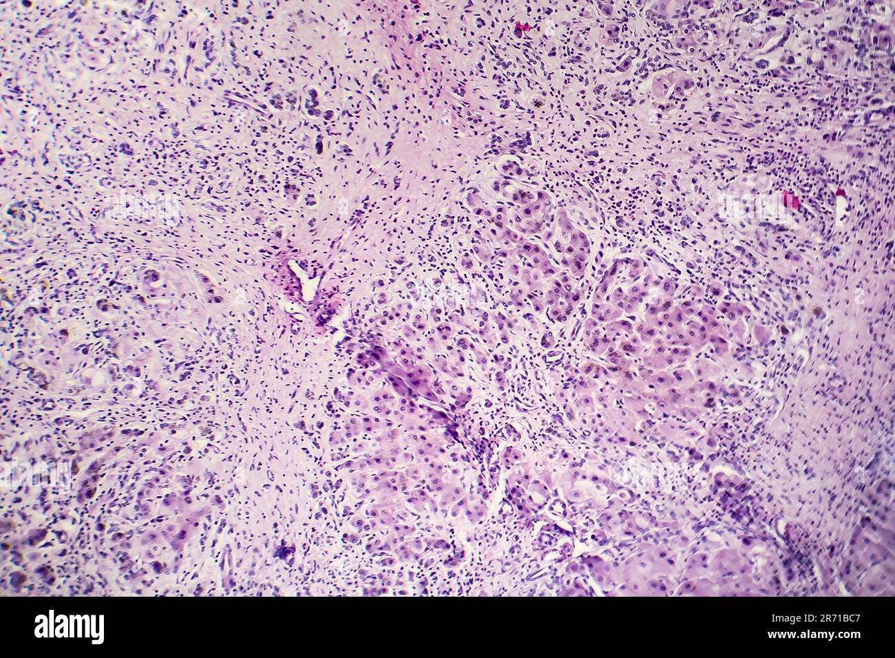 Histopathology of postnecrotic liver cirrhosis, light micrograph, photo  under microscope Stock Photo - Alamy