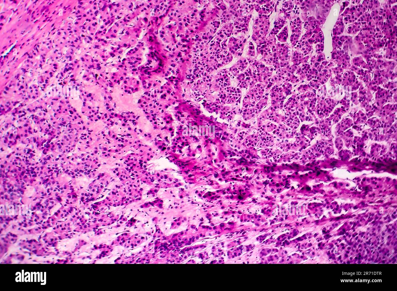 Hepatocellular carcinoma, cancer of liver, light micrograph, photo ...