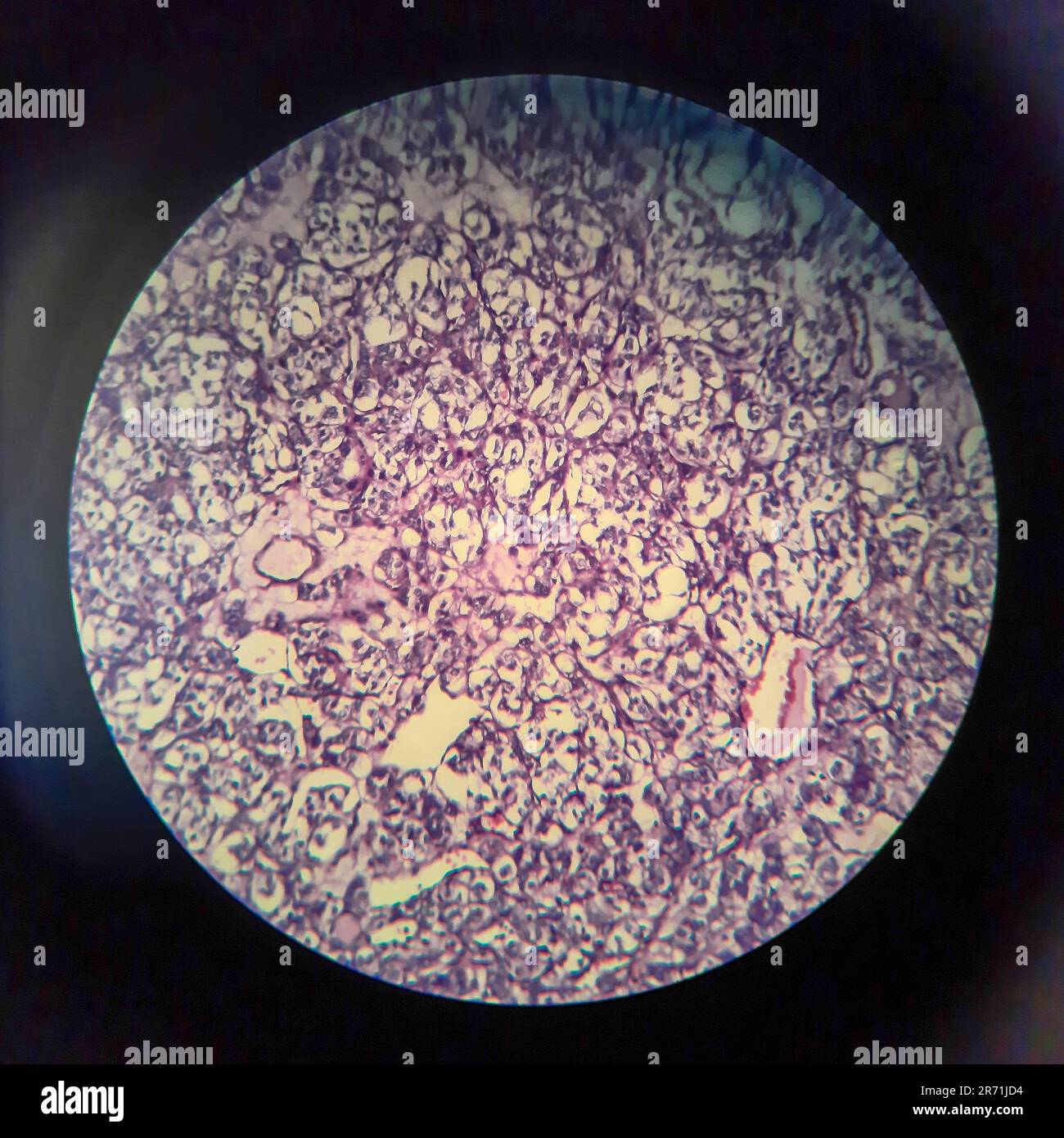 Thyroid follicular carcinoma, light micrograph, photo under microscope Stock Photo