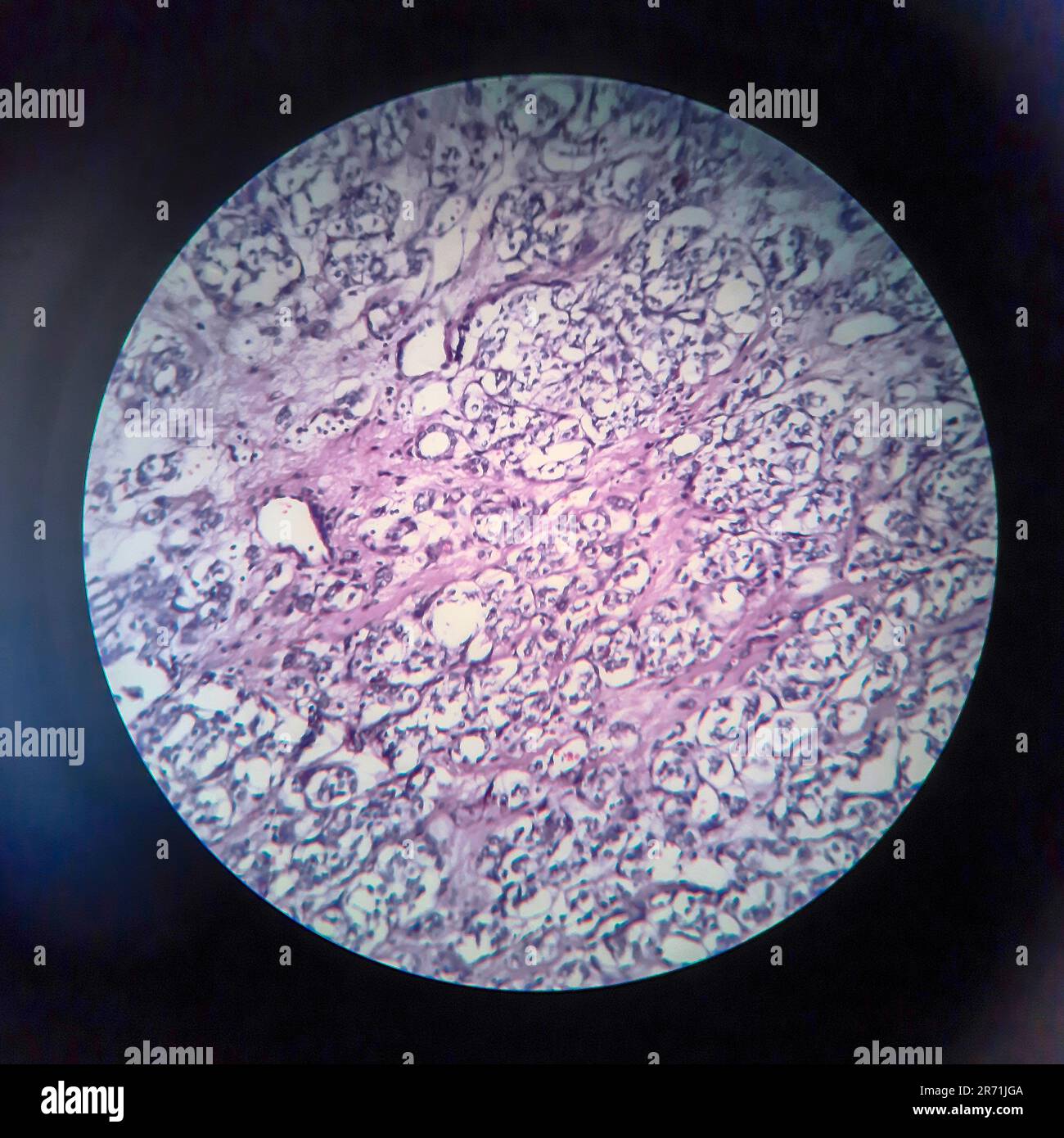 Thyroid follicular carcinoma, light micrograph, photo under microscope Stock Photo