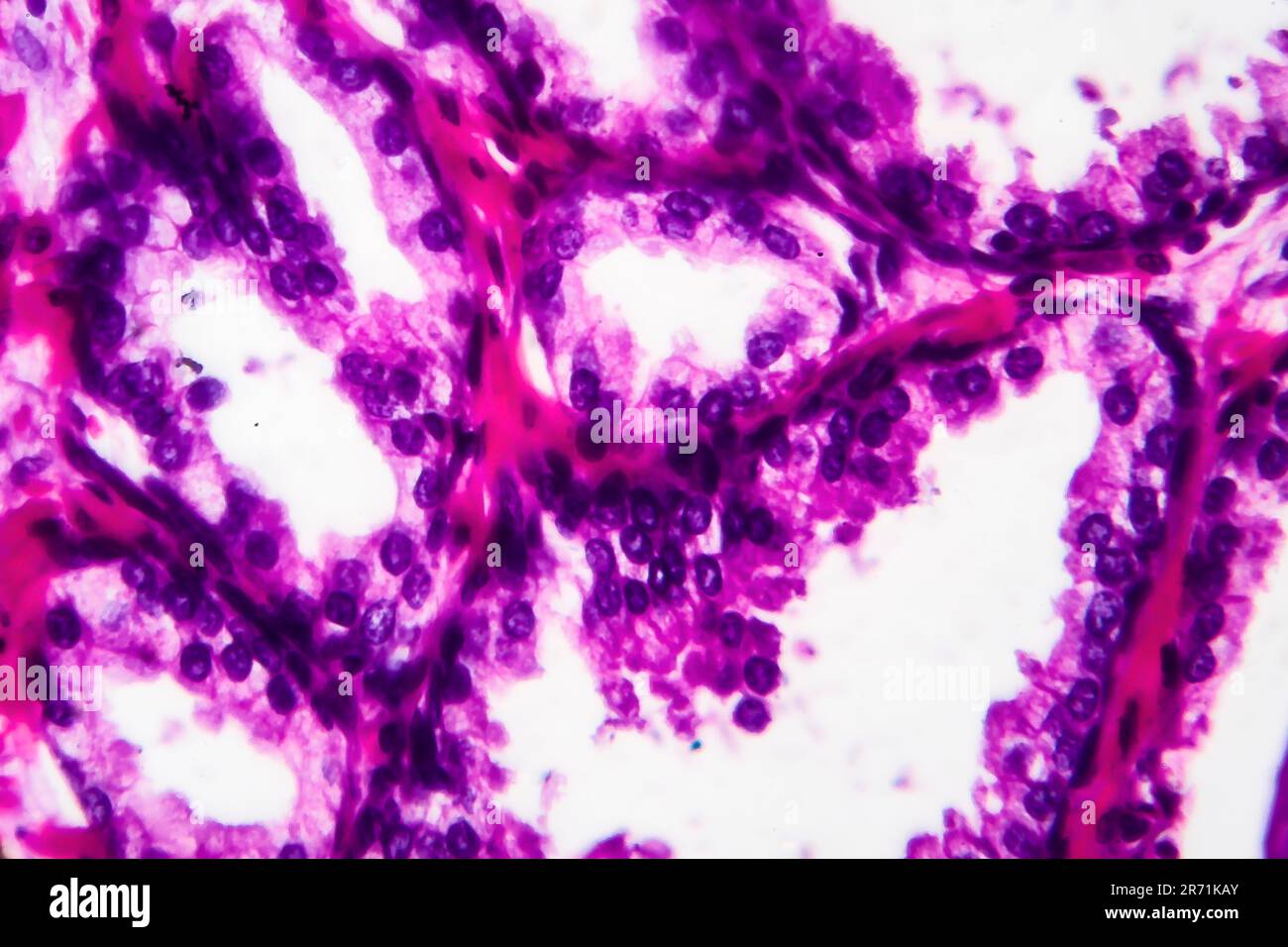 Benign prostatic hyperplasia, light micrograph, photo under microscope