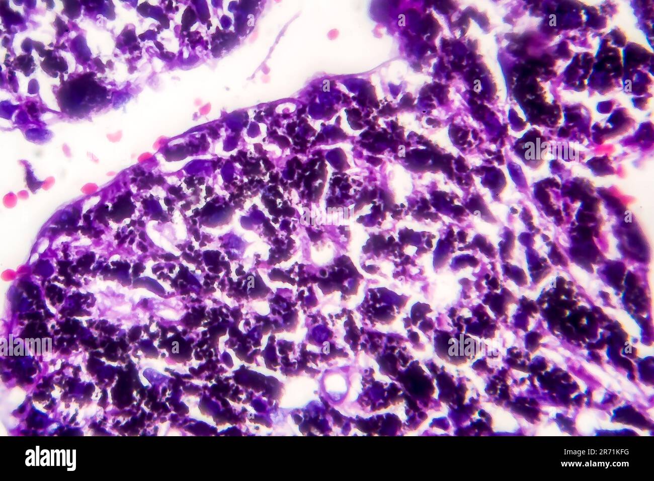 Histopathology of smoker's lung. Light micrograph showing accumulation of carbon particles in lung tissue Stock Photo