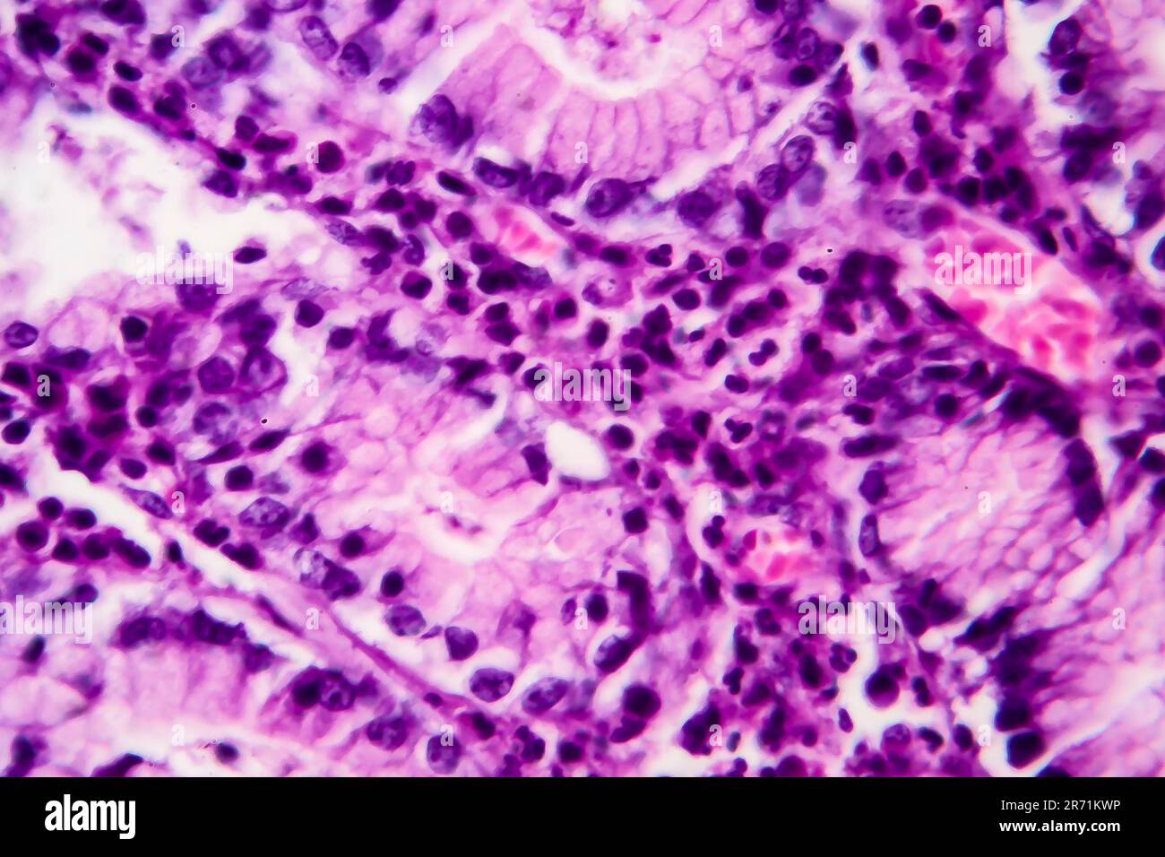 Histopathology of stomach adenocarcinoma, light micrograph, photo under microscope Stock Photo